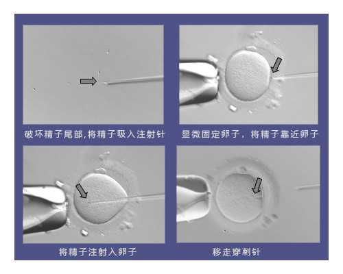 北京一中心供卵,北京海总做试管