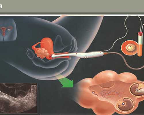 北京单身代怀,北京正规捐卵多少钱,北京捐卵多少钱